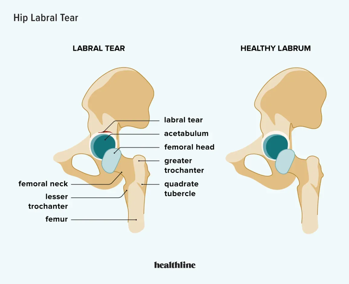 Understanding The Hip Labrum And Hip Labral Tears